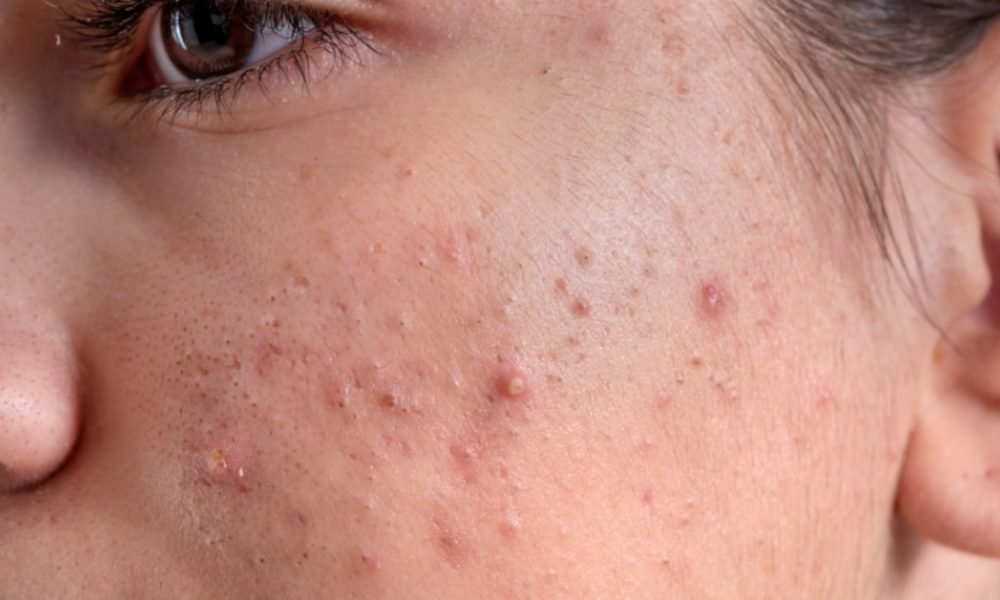 Camomila na pele: como usar o ingrediente natural para combater a acne e controlar a oleosidade