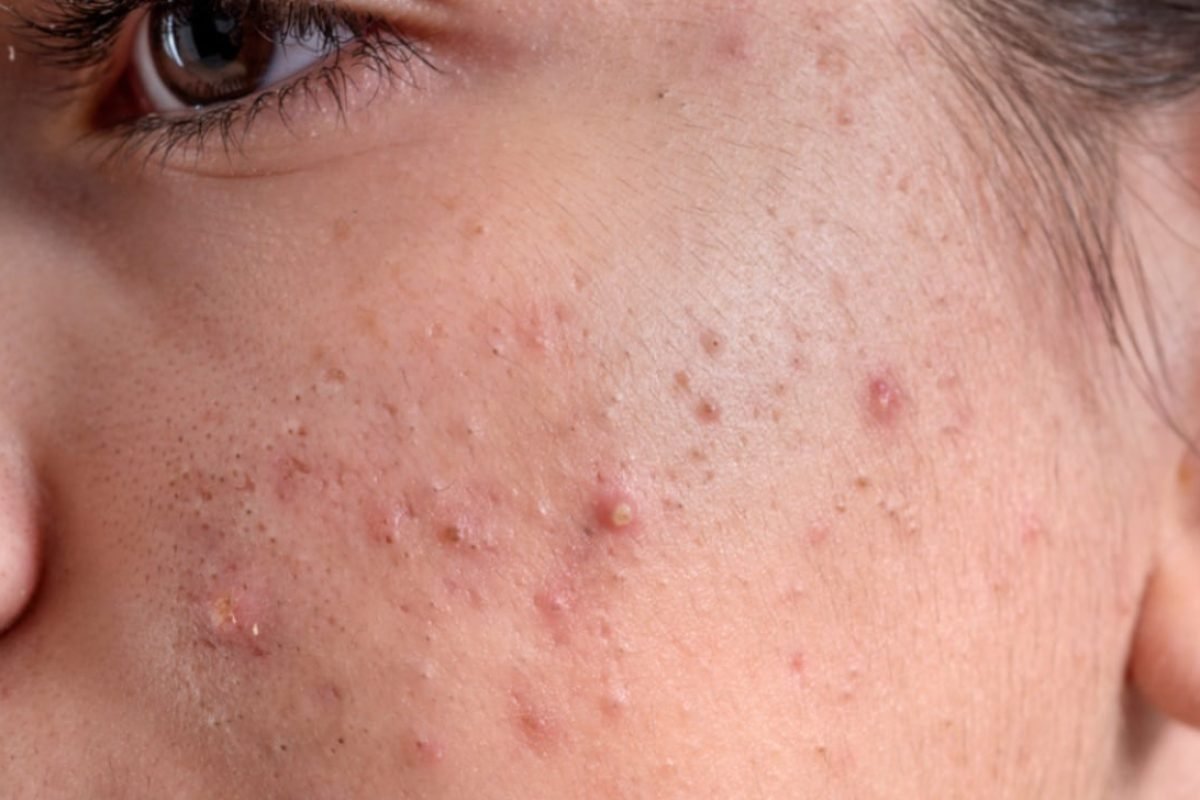 Camomila na pele: como usar o ingrediente natural para combater a acne e controlar a oleosidade