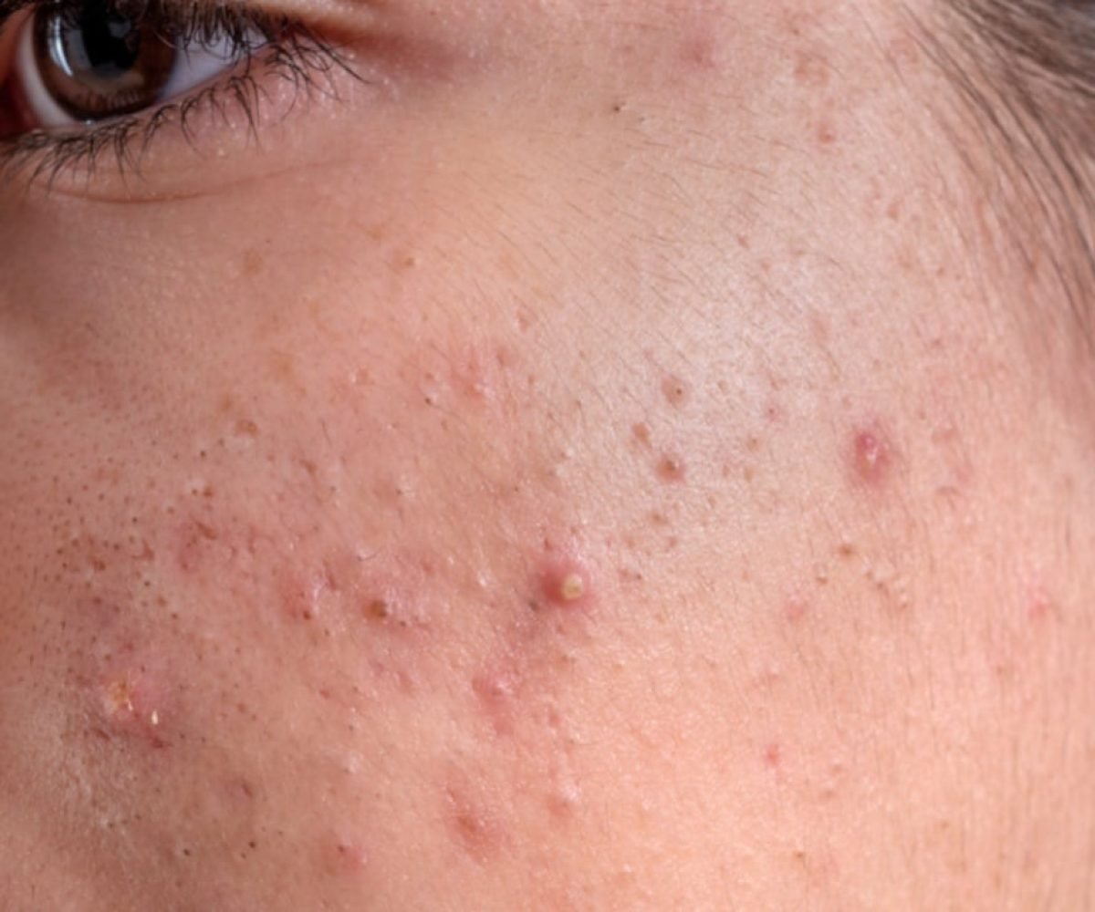 Camomila na pele: como usar o ingrediente natural para combater a acne e controlar a oleosidade